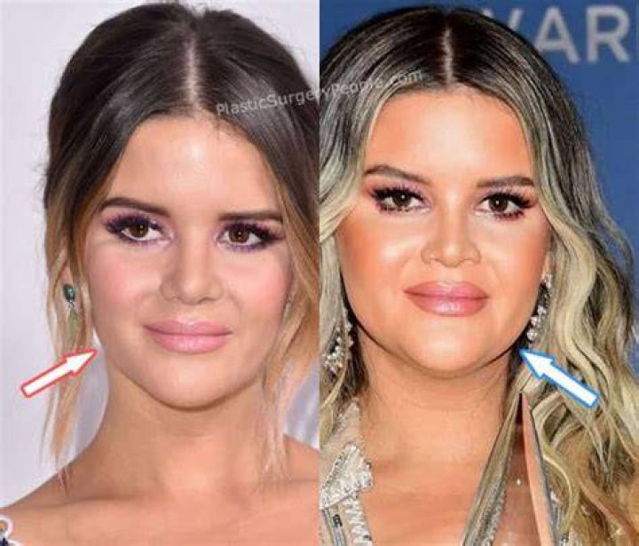 Did Maren Morris Get Botox? Here Is What The Singer Looks Before & After Plastic Surgery