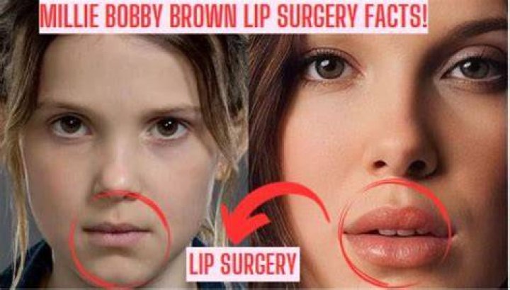Has Millie Bobby Brown Done Lip Filler? Fans Suspect Botox And Nose Job!