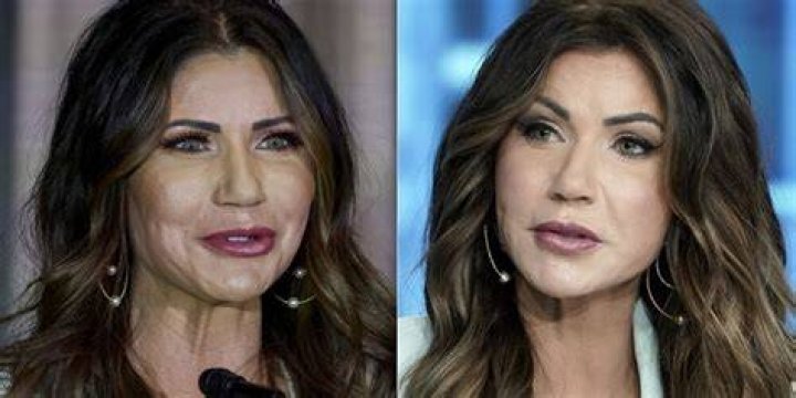 Kristi Noem Plastic Surgery- Before & After Pictures Depicts A Clear Difference