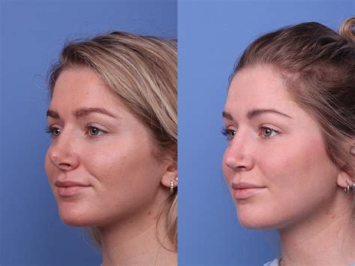 Melissa Barrera Plastic Surgery Before And After | Health Update