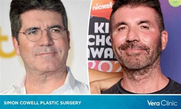 
Simon Cowell Before And After Looks: The X Factor Creator Went Too Far With The Plastic Surgery 
