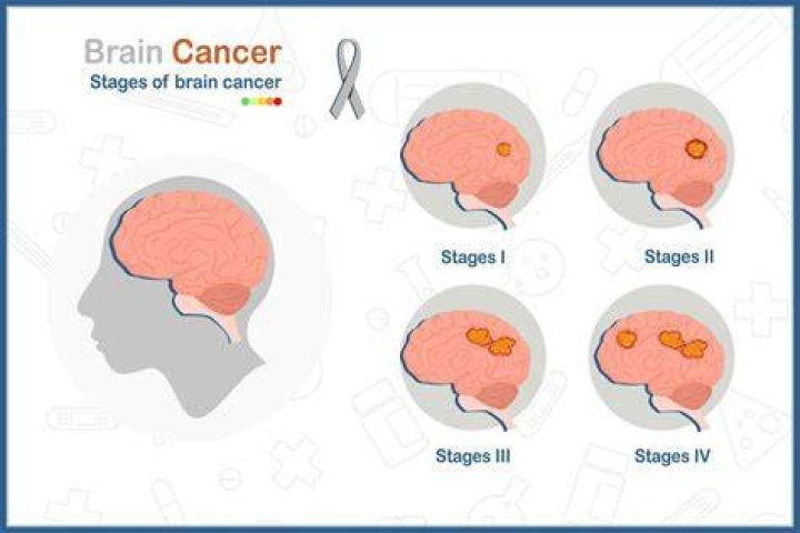 
Simon Roy Brain Cancer Stage And Health Canadian Author Publishes “My End Of The World” 